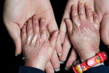تحریم دارویی بیماران پروانه‌ای از سوی سوئد